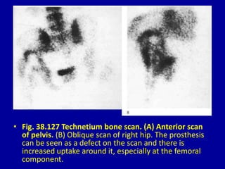 • Fig. 38.127 Technetium bone scan. (A) Anterior scan
of pelvis. (B) Oblique scan of right hip. The prosthesis
can be seen as a defect on the scan and there is
increased uptake around it, especially at the femoral
component.
 