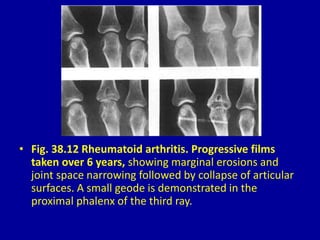 • Fig. 38.12 Rheumatoid arthritis. Progressive films
taken over 6 years, showing marginal erosions and
joint space narrowing followed by collapse of articular
surfaces. A small geode is demonstrated in the
proximal phalenx of the third ray.
 