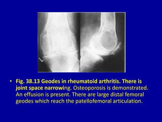 • Fig. 38.13 Geodes in rheumatoid arthritis. There is
joint space narrowing. Osteoporosis is demonstrated.
An effusion is present. There are large distal femoral
geodes which reach the patellofemoral articulation.
 