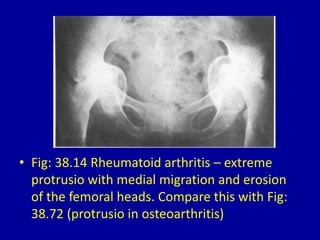 • Fig: 38.14 Rheumatoid arthritis – extreme
protrusio with medial migration and erosion
of the femoral heads. Compare this with Fig:
38.72 (protrusio in osteoarthritis)
 