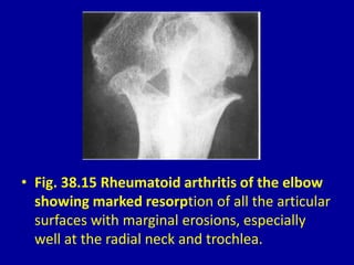 • Fig. 38.15 Rheumatoid arthritis of the elbow
showing marked resorption of all the articular
surfaces with marginal erosions, especially
well at the radial neck and trochlea.
 