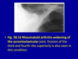 • Fig. 38.16 Rheumatoid arthritis-widening of
the acromioclavicular joint. Erosion of the
third and fourth ribs superiorly is also seen in
this condition.
 