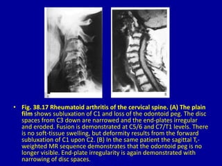 • Fig. 38.17 Rheumatoid arthritis of the cervical spine. (A) The plain
film shows subluxation of C1 and loss of the odontoid peg. The disc
spaces from C3 down are narrowed and the end-plates irregular
and eroded. Fusion is demonstrated at C5/6 and C7/T1 levels. There
is no soft-tissue swelling, but deformity results from the forward
subluxation of C1 upon C2. (B) In the same patient the sagittal T,-
weighted MR sequence demonstrates that the odontoid peg is no
longer visible. End-plate irregularity is again demonstrated with
narrowing of disc spaces.
 