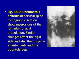 • Fig. 38.18 Rheumatoid
arthritis of cervical spine-
tomographic section
showing erosions of the
left atlanto-axial
articulation. Similar
changes affect the right
side and also the occipito-
atlanto joints and the
odontoid peg.
 