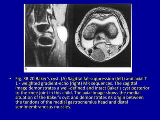 • Fig. 38.20 Baker's cyst. (A) Sagittal fat-suppression (left) and axial T
1 - weighted gradient-echo (right) MR sequences. The sagittal
image demonstrates a well-defined and intact Baker's cyst posterior
to the knee joint in this child. The axial image shows the medial
situation of the Baker's cyst and demonstrates its origin between
the tendons of the medial gastrocnemius head and distal
semimembranosus muscles.
 
