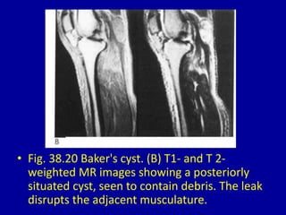 • Fig. 38.20 Baker's cyst. (B) T1- and T 2-
weighted MR images showing a posteriorly
situated cyst, seen to contain debris. The leak
disrupts the adjacent musculature.
 
