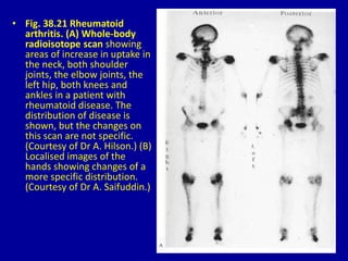 • Fig. 38.21 Rheumatoid
arthritis. (A) Whole-body
radioisotope scan showing
areas of increase in uptake in
the neck, both shoulder
joints, the elbow joints, the
left hip, both knees and
ankles in a patient with
rheumatoid disease. The
distribution of disease is
shown, but the changes on
this scan are not specific.
(Courtesy of Dr A. Hilson.) (B)
Localised images of the
hands showing changes of a
more specific distribution.
(Courtesy of Dr A. Saifuddin.)
 