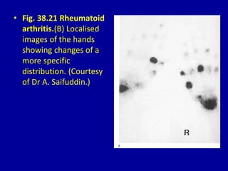 • Fig. 38.21 Rheumatoid
arthritis.(B) Localised
images of the hands
showing changes of a
more specific
distribution. (Courtesy
of Dr A. Saifuddin.)
 