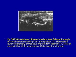 • Fig. 38.23 Coronal scan of lateral meniscal tear. Echogenic margin
of lateral femoral condyle (F) and tibial plateau (T), intermediate
lower echogenicity of meniscus (M) with torn fragment (*), areas of
anechoic fluid of the meniscal cyst (Cy) arising from the tear.
 