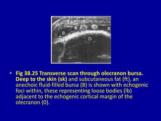 • Fig 38.25 Transverse scan through olecranon bursa.
Deep to the skin (sk) and subcutaneous fat (ft), an
anechoic fluid-filled bursa (B) is shown with echogenic
foci within, these representing loose bodies (lb)
adjacent to the echogenic cortical margin of the
olecranon (0).
 