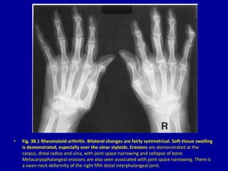 • Fig. 38.1 Rheumatoid arthritis. Bilateral changes are fairly symmetrical. Soft-tissue swelling
is demonstrated, especially over the ulnar styloids. Erosions are demonstrated at the
carpus, distal radius and ulna, with joint space narrowing and collapse of bone.
Metacarpophalangeal erosions are also seen associated with joint space narrowing. There is
a swan-neck deformity of the right fifth distal interphalangeal joint.
 