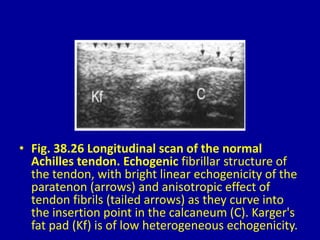 • Fig. 38.26 Longitudinal scan of the normal
Achilles tendon. Echogenic fibrillar structure of
the tendon, with bright linear echogenicity of the
paratenon (arrows) and anisotropic effect of
tendon fibrils (tailed arrows) as they curve into
the insertion point in the calcaneum (C). Karger's
fat pad (Kf) is of low heterogeneous echogenicity.
 