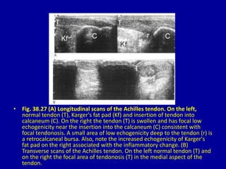 • Fig. 38.27 (A) Longitudinal scans of the Achilles tendon. On the left,
normal tendon (T), Karger's fat pad (Kf) and insertion of tendon into
calcaneum (C). On the right the tendon (T) is swollen and has focal low
echogenicity near the insertion into the calcaneum (C) consistent with
focal tendonosis. A small area of low echogenicity deep to the tendon (r) is
a retrocalcaneal bursa. Also, note the increased echogenicity of Karger's
fat pad on the right associated with the inflammatory change. (B)
Transverse scans of the Achilles tendon. On the left normal tendon (T) and
on the right the focal area of tendonosis (T) in the medial aspect of the
tendon.
 