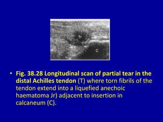 • Fig. 38.28 Longitudinal scan of partial tear in the
distal Achilles tendon (T) where torn fibrils of the
tendon extend into a liquefied anechoic
haematoma Jr) adjacent to insertion in
calcaneum (C).
 