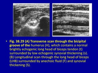 • Fig. 38.29 (A) Transverse scan through the bicipital
groove of the humerus (H), which contains a normal
brightly echogenic long head of biceps tendon (t)
surrounded by low echogenic synovial thickening (s).
(B) Longitudinal scan through the long head of biceps
(LHB) surrounded by anechoic fluid (F) and synovial
thickening (S).
 