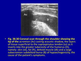 • Fig. 38.30 Coronal scan through the shoulder showing the
tip of the acromion (Ac) casting acoustic shadow, the layers
of tissue superficial to the supraspinatus tendon (ss) as it
inserts into the greater tuberosity of the humerus (H),
namely: skin (sk), fat (ft), deltoid muscle (dt) and a large
subacromion subdeltoid bursa (B) of hypoechogenicity, the
cause of the patient's symptoms.
 