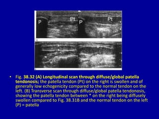 • Fig. 38.32 (A) Longitudinal scan through diffuse/global patella
tendonosis; the patella tendon (Pt) on the right is swollen and of
generally low echogenicity compared to the normal tendon on the
left. (B) Transverse scan through diffuse/global patella tendonosis,
showing the patella tendon between * on the right being diffusely
swollen compared to Fig. 38.31B and the normal tendon on the left
(P) = patella
 
