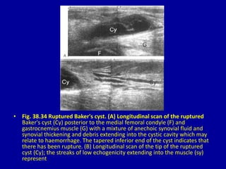 • Fig. 38.34 Ruptured Baker's cyst. (A) Longitudinal scan of the ruptured
Baker's cyst (Cy) posterior to the medial femoral condyle (F) and
gastrocnemius muscle (G) with a mixture of anechoic synovial fluid and
synovial thickening and debris extending into the cystic cavity which may
relate to haemorrhage. The tapered inferior end of the cyst indicates that
there has been rupture. (B) Longitudinal scan of the tip of the ruptured
cyst (Cy); the streaks of low echogenicity extending into the muscle (sy)
represent
 