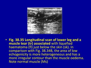 • Fig. 38.35 Longitudinal scan of lower leg and a
muscle tear (tr) associated with liquefied
haematoma (fl) just below the skin (sk). In
comparison with Fig. 38.34B, the area of low
echogenicity is more heterogeneous and has a
more irregular contour than the muscle oedema.
Note normal muscle (Ms)
 
