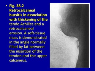 • Fig. 38.2
Retrocalcaneal
bursitis in association
with thickening of the
tendo Achilles and a
retrocalcaneal
erosion. A soft-tissue
mass is demonstrated
in the angle normally
filled by fat between
the insertion of the
tendon and the upper
calcaneus.
 