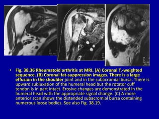 • Fig. 38.36 Rheumatoid arthritis at MRI. (A) Coronal T,-weighted
sequence. (B) Coronal fat-suppression images. There is a large
effusion in the shoulder joint and in the subacromial bursa. There is
upward subluxation of the humeral head but the rotator cuff
tendon is in part intact. Erosive changes are demonstrated in the
humeral head with the appropriate signal change. (C) A more
anterior scan shows the distended subacromial bursa containing
numerous loose bodies. See also Fig. 38.19.
 