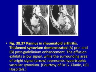 • Fig. 38.37 Pannus in rheumatoid arthritis.
Thickened synovium demonstrated (A) pre- and
(B) post-gadolinium enhancement. The effusion
exhibits a low signal, while the surrounding area
of bright signal (arrow) represents hypertrophic
vascular synovium. (Courtesy of Dr G. Clunie, UCL
Hospitals.)
 