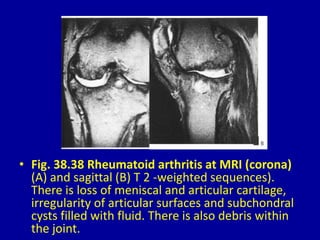 • Fig. 38.38 Rheumatoid arthritis at MRI (corona)
(A) and sagittal (B) T 2 -weighted sequences).
There is loss of meniscal and articular cartilage,
irregularity of articular surfaces and subchondral
cysts filled with fluid. There is also debris within
the joint.
 