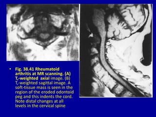 • Fig. 38.41 Rheumatoid
arthritis at MR scanning. (A)
T,-weighted axial image. (B)
T,-weighted sagittal image. A
soft-tissue mass is seen in the
region of the eroded odontoid
peg and this indents the cord.
Note distal changes at all
levels in the cervical spine
 