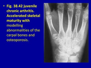 • Fig. 38.42 juvenile
chronic arthritis.
Accelerated skeletal
maturity with
modelling
abnormalities of the
carpal bones and
osteoporosis.
 