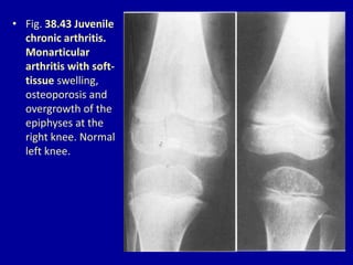 • Fig. 38.43 Juvenile
chronic arthritis.
Monarticular
arthritis with soft-
tissue swelling,
osteoporosis and
overgrowth of the
epiphyses at the
right knee. Normal
left knee.
 