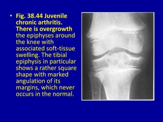 • Fig. 38.44 Juvenile
chronic arthritis.
There is overgrowth
the epiphyses around
the knee with
associated soft-tissue
swelling. The tibial
epiphysis in particular
shows a rather square
shape with marked
angulation of its
margins, which never
occurs in the normal.
 