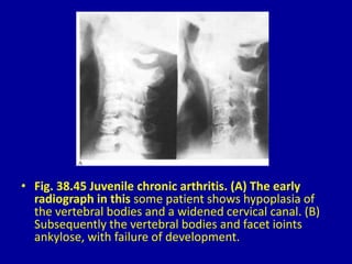 • Fig. 38.45 Juvenile chronic arthritis. (A) The early
radiograph in this some patient shows hypoplasia of
the vertebral bodies and a widened cervical canal. (B)
Subsequently the vertebral bodies and facet ioints
ankylose, with failure of development.
 