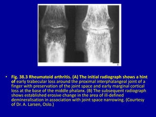 • Fig. 38.3 Rheumatoid arthritis. (A) The initial radiograph shows a hint
of early trabecular loss around the proximal interphalangeal joint of a
finger with preservation of the joint space and early marginal cortical
loss at the base of the middle phalanx. (B) The subsequent radiograph
shows established erosive change in the area of ill-defined
demineralisation in association with joint space narrowing. (Courtesy
of Dr. A. Larsen, Oslo.)
 
