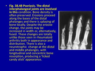 • Fig. 38.48 Psoriasis. The distal
interphalangeal joints are involved
in this condition. Bone density is
often preserved. Erosions proceed
along the bases of the distal
phalanges and there is splaying of
bone locally. Despite the erosive
change, the joints may be
increased in width or, alternatively,
fused. These changes are totally
unlike those seen in rheumatoid
arthritis both in appearance and
distribution. There is also a
neurotrophic change at the distal
and middle phalanges, with
longitudinal and concentric bone
resorption, producing a 'licked
candy stick' appearance.
 