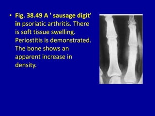 • Fig. 38.49 A ' sausage digit'
in psoriatic arthritis. There
is soft tissue swelling.
Periostitis is demonstrated.
The bone shows an
apparent increase in
density.
 