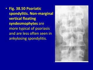 • Fig. 38.50 Psoriatic
spondylitis. Non-marginal
vertical floating
syndesmophytes are
more typical of psoriasis
and are less often seen in
ankylosing spondylitis.
 
