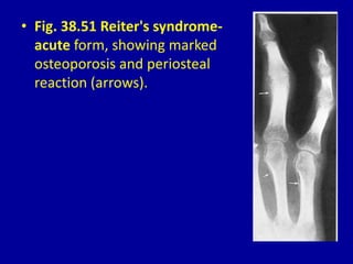 • Fig. 38.51 Reiter's syndrome-
acute form, showing marked
osteoporosis and periosteal
reaction (arrows).
 