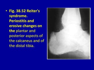 • Fig. 38.52 Reiter's
syndrome.
Periostitis and
erosive changes on
the plantar and
posterior aspects of
the calcaneus and of
the distal tibia.
 