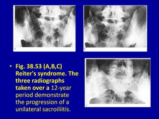 • Fig. 38.53 (A,B,C)
Reiter's syndrome. The
three radiographs
taken over a 12-year
period demonstrate
the progression of a
unilateral sacroiliitis.
 