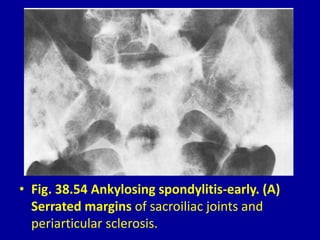 • Fig. 38.54 Ankylosing spondylitis-early. (A)
Serrated margins of sacroiliac joints and
periarticular sclerosis.
 