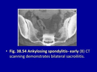 • Fig. 38.54 Ankylosing spondylitis- early (B) CT
scanning demonstrates bilateral sacroiliitis.
 