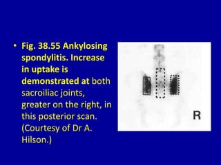 • Fig. 38.55 Ankylosing
spondylitis. Increase
in uptake is
demonstrated at both
sacroiliac joints,
greater on the right, in
this posterior scan.
(Courtesy of Dr A.
Hilson.)
 