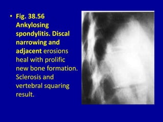 • Fig. 38.56
Ankylosing
spondylitis. Discal
narrowing and
adjacent erosions
heal with prolific
new bone formation.
Sclerosis and
vertebral squaring
result.
 