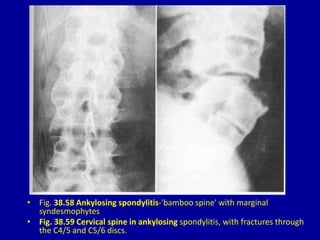 • Fig. 38.58 Ankylosing spondylitis-'bamboo spine' with marginal
syndesmophytes
• Fig. 38.59 Cervical spine in ankylosing spondylitis, with fractures through
the C4/5 and C5/6 discs.
 