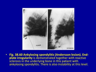 • Fig. 38.60 Ankylosing spondylitis (Andersson lesion). End-
plate irregularity is demonstrated together with reactive
sclerosis in the underlying bone in this patient with
ankylosing spondylitis. There is also instability at this level.
 