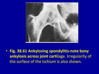 • Fig. 38.61 Ankylosing spondylitis-note bony
ankylosis across joint cartilage. Irregularity of
the surface of the ischium is also shown.
 