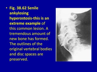 • Fig. 38.62 Senile
ankylosing
hyperostosis-this is an
extreme example of
this common lesion. A
tremendous amount of
new bone has formed.
The outlines of the
original vertebral bodies
and disc spaces are
preserved.
 