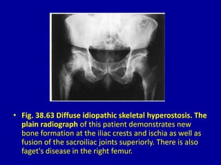 • Fig. 38.63 Diffuse idiopathic skeletal hyperostosis. The
plain radiograph of this patient demonstrates new
bone formation at the iliac crests and ischia as well as
fusion of the sacroiliac joints superiorly. There is also
faget's disease in the right femur.
 