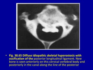 • Fig. 38.65 Diffuse idiopathic skeletal hyperostosis with
ossification of the posterior longitudinal ligament. New
bone is seen anteriorly on this cervical vertebral body and
posteriorly in the canal along the line of the posterior
 