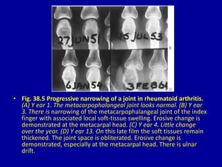 • Fig. 38.5 Progressive narrowing of a joint in rheumatoid arthritis.
(A) Y ear 1. The metacarpophalangeal joint looks normal. (B) Y ear
3. There is narrowing of the metacarpophalangeal joint of the index
finger with associated local soft-tissue swelling. Erosive change is
demonstrated at the metacarpal head. (C) Y ear 4. Little change
over the year. (D) Y ear 13. On this late film the soft tissues remain
thickened. The joint space is obliterated. Erosive change is
demonstrated, especially at the metacarpal head. There is ulnar
drift.
 